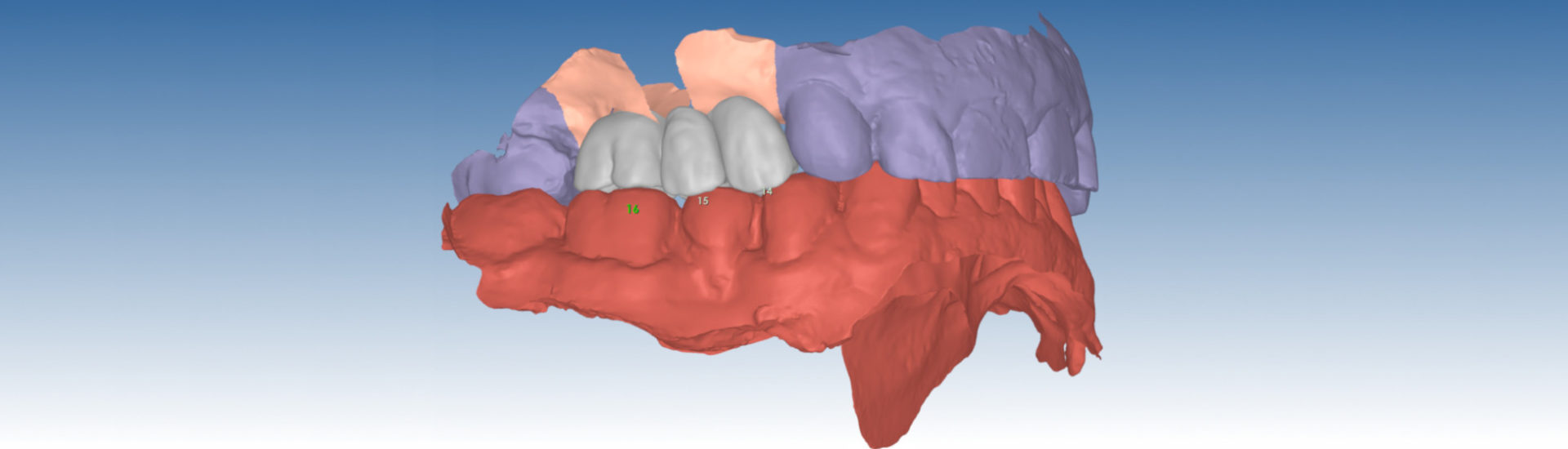 realizzazioni-digitali-laboratorio-odontotecnico-santini