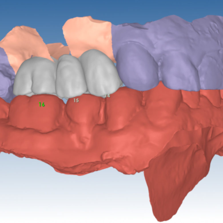 realizzazioni-digitali-laboratorio-odontotecnico-santini